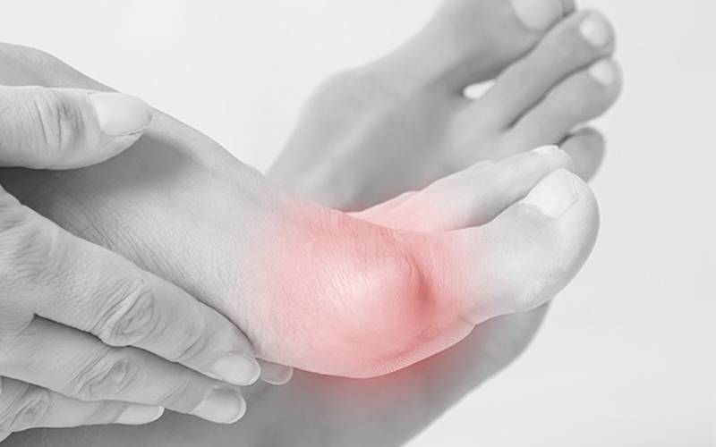 Bunions: Prevention and Care