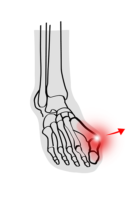 Hallux Valgus