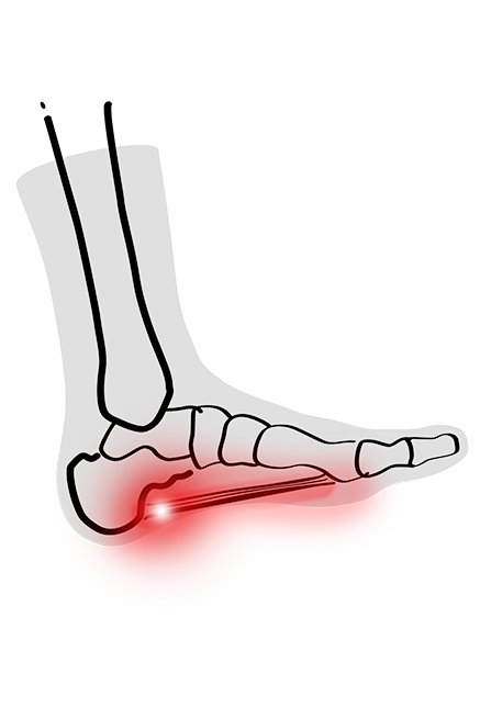 Plantarfasziitis