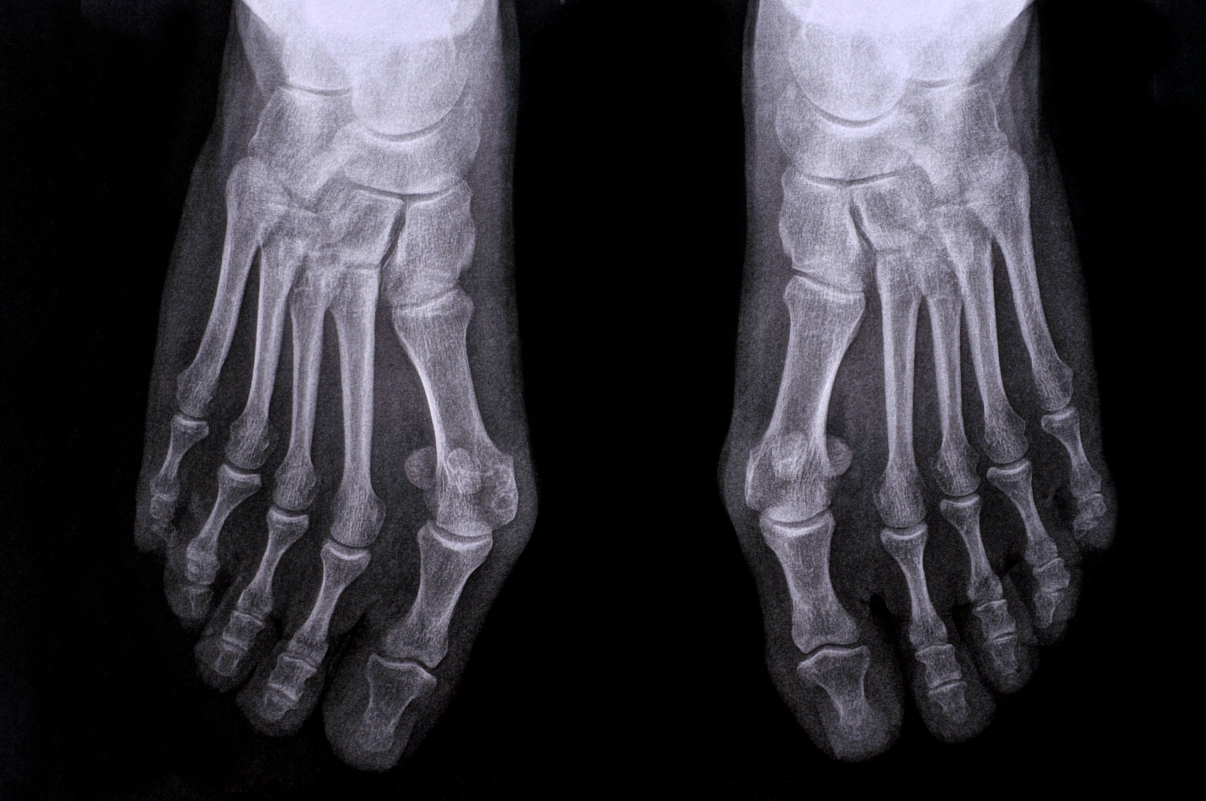 Was verursacht einen Hallux valgus?