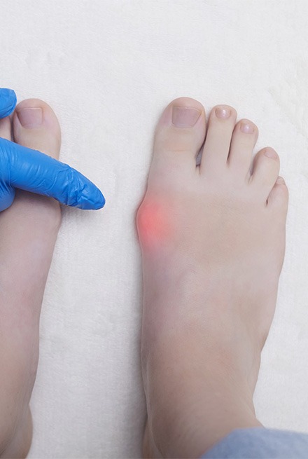 How are Bunions Diagnosed?